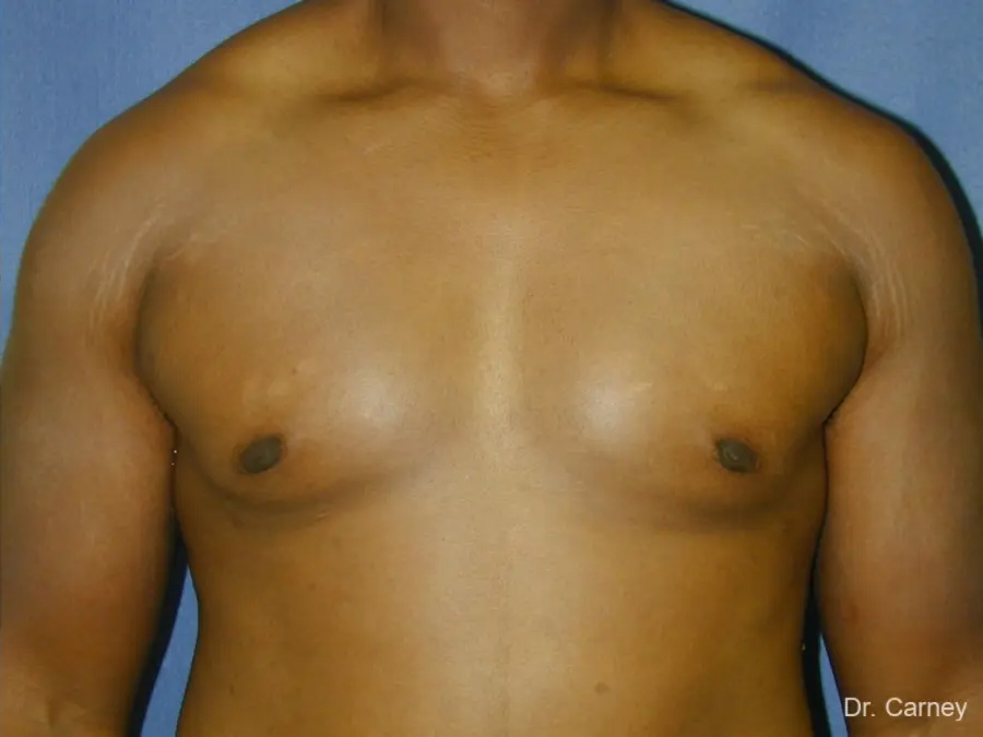 Gynecomastia Real Patient Results by Dr. Martin Carney and Dr. Martin Carney III of The Carney Center in Virginia Beach and Newport News