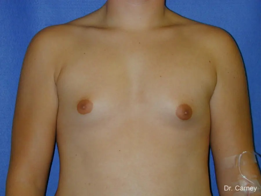Gynecomastia Real Patient Results by Dr. Martin Carney and Dr. Martin Carney III of The Carney Center in Virginia Beach and Newport News