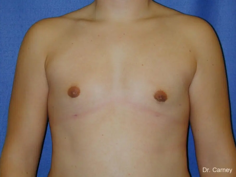 Gynecomastia Real Patient Results by Dr. Martin Carney and Dr. Martin Carney III of The Carney Center in Virginia Beach and Newport News