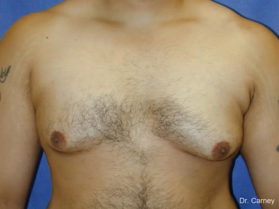 Gynecomastia Real Patient Results by Dr. Martin Carney and Dr. Martin Carney III of The Carney Center in Virginia Beach and Newport News