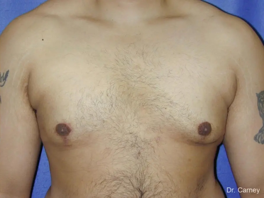 Gynecomastia Real Patient Results by Dr. Martin Carney and Dr. Martin Carney III of The Carney Center in Virginia Beach and Newport News