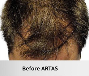 Hair Restoration Real Patient Results by Dr. Martin Carney and Dr. Martin Carney III of The Carney Center in Virginia Beach and Newport News