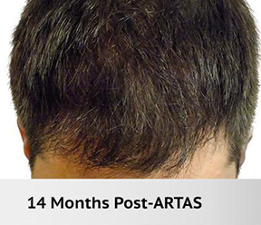 Hair Restoration Real Patient Results by Dr. Martin Carney and Dr. Martin Carney III of The Carney Center in Virginia Beach and Newport News
