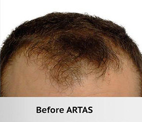 Hair Restoration Real Patient Results by Dr. Martin Carney and Dr. Martin Carney III of The Carney Center in Virginia Beach and Newport News