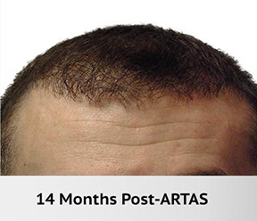 Hair Restoration Real Patient Results by Dr. Martin Carney and Dr. Martin Carney III of The Carney Center in Virginia Beach and Newport News