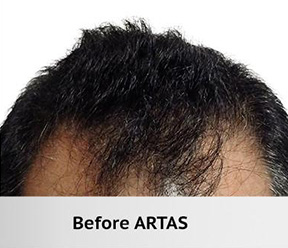 Hair Restoration Real Patient Results by Dr. Martin Carney and Dr. Martin Carney III of The Carney Center in Virginia Beach and Newport News
