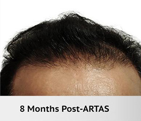 Hair Restoration Real Patient Results by Dr. Martin Carney and Dr. Martin Carney III of The Carney Center in Virginia Beach and Newport News