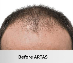 Hair Restoration Real Patient Results by Dr. Martin Carney and Dr. Martin Carney III of The Carney Center in Virginia Beach and Newport News