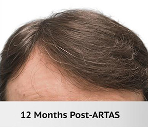 Hair Restoration Real Patient Results by Dr. Martin Carney and Dr. Martin Carney III of The Carney Center in Virginia Beach and Newport News