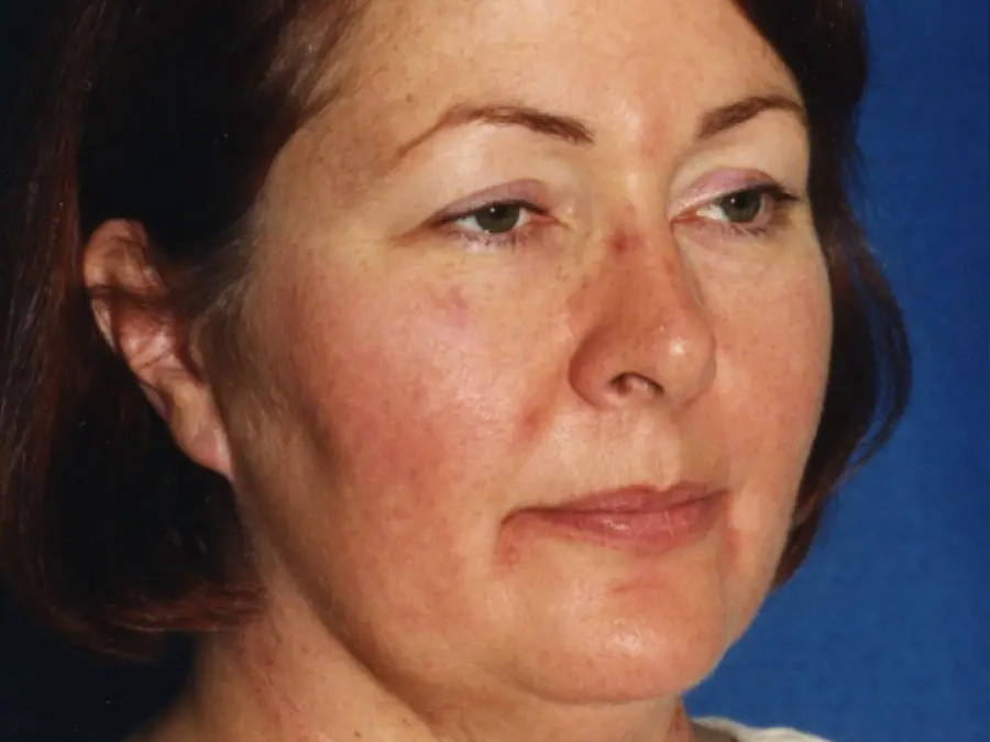 Laser Skin Resurfacing Real Patient Results by Dr. Martin Carney and Dr. Martin Carney III of The Carney Center in Virginia Beach and Newport News