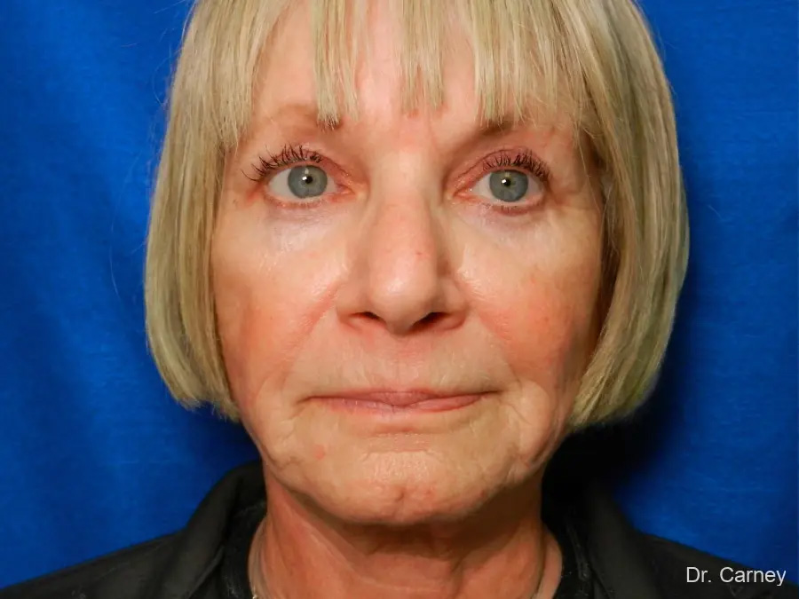 Laser Skin Resurfacing Real Patient Results by Dr. Martin Carney and Dr. Martin Carney III of The Carney Center in Virginia Beach and Newport News