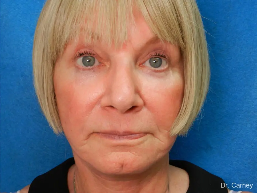 Laser Skin Resurfacing Real Patient Results by Dr. Martin Carney and Dr. Martin Carney III of The Carney Center in Virginia Beach and Newport News