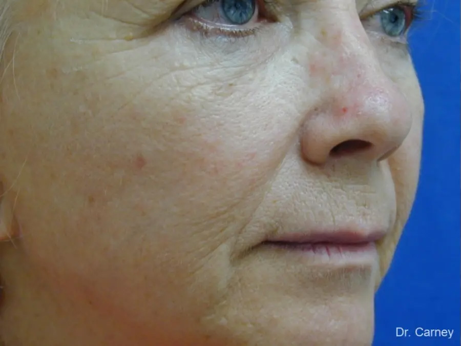 Laser Skin Resurfacing Real Patient Results by Dr. Martin Carney and Dr. Martin Carney III of The Carney Center in Virginia Beach and Newport News