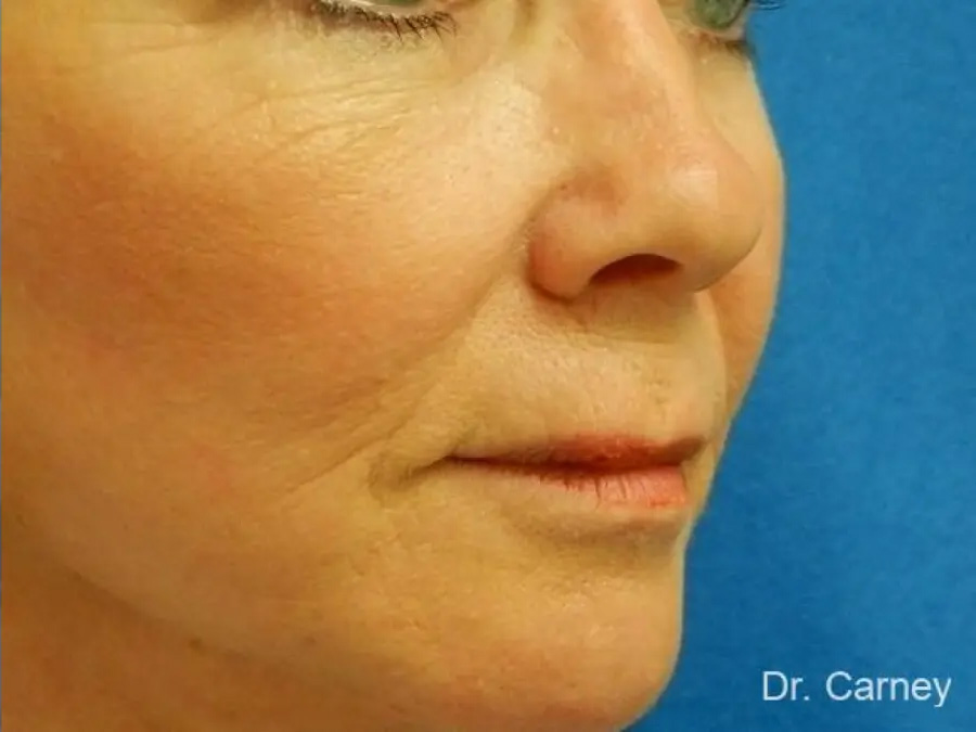 Laser Skin Resurfacing Real Patient Results by Dr. Martin Carney and Dr. Martin Carney III of The Carney Center in Virginia Beach and Newport News