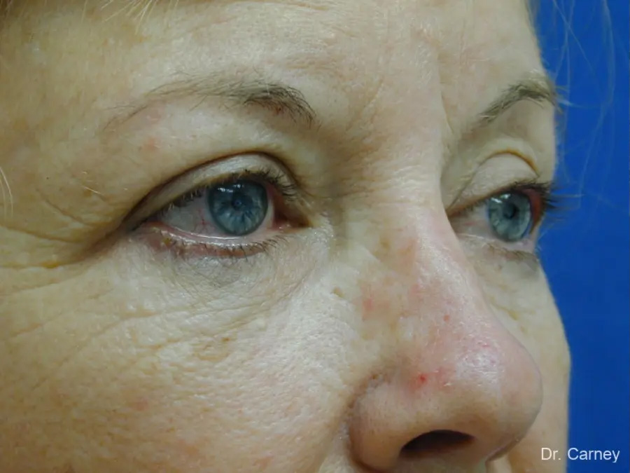 Laser Skin Resurfacing Real Patient Results by Dr. Martin Carney and Dr. Martin Carney III of The Carney Center in Virginia Beach and Newport News