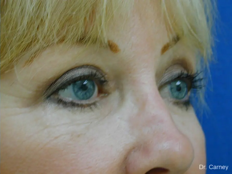 Laser Skin Resurfacing Real Patient Results by Dr. Martin Carney and Dr. Martin Carney III of The Carney Center in Virginia Beach and Newport News