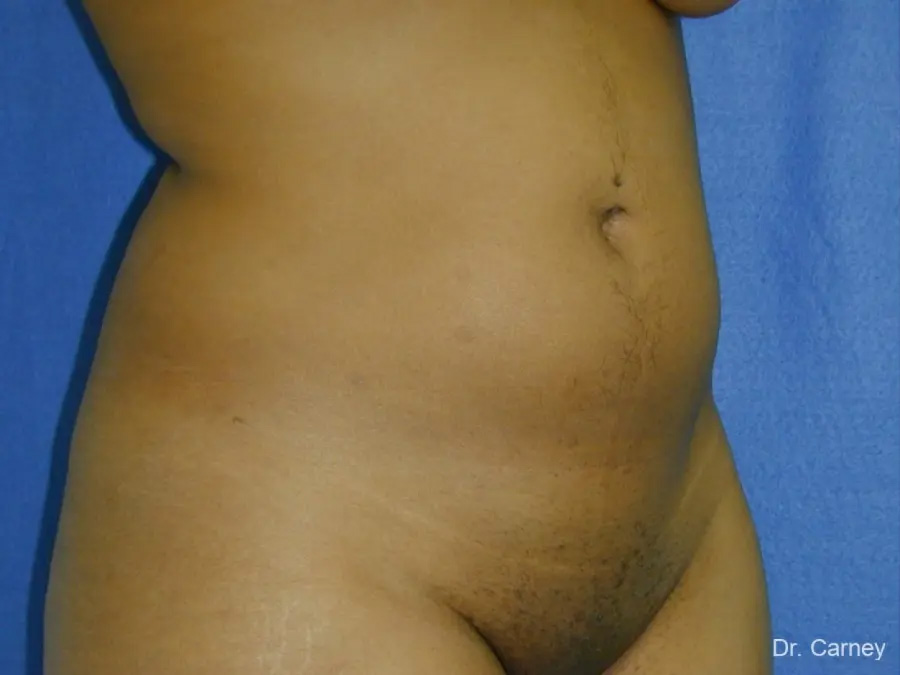 Liposuction Real Patient Results by Dr. Martin Carney and Dr. Martin Carney III of The Carney Center in Virginia Beach and Newport News