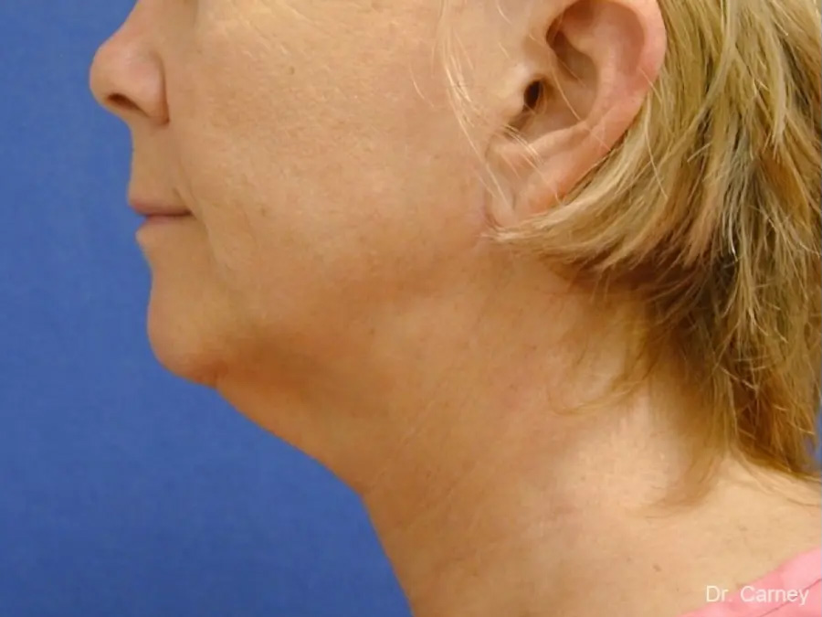 Neck Lift Real Patient Results by Dr. Martin Carney and Dr. Martin Carney III of The Carney Center in Virginia Beach and Newport News