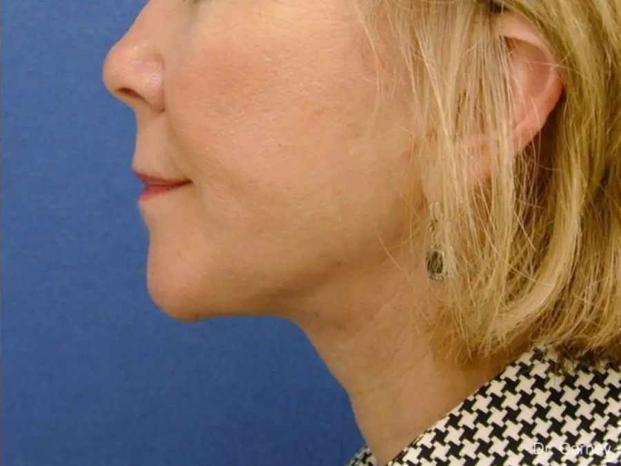 Neck Lift Real Patient Results by Dr. Martin Carney and Dr. Martin Carney III of The Carney Center in Virginia Beach and Newport News