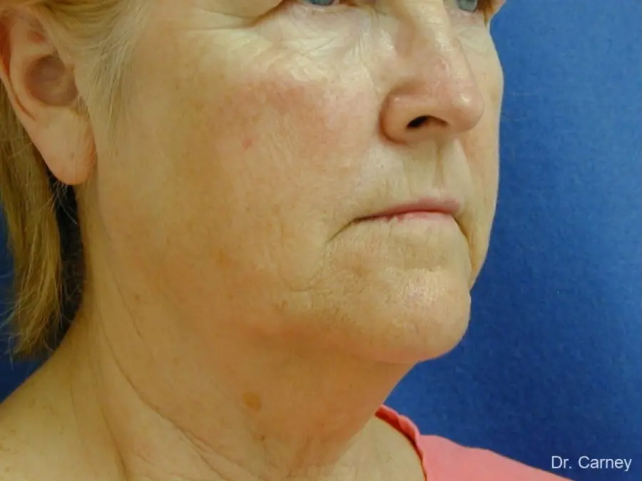 Neck Lift Real Patient Results by Dr. Martin Carney and Dr. Martin Carney III of The Carney Center in Virginia Beach and Newport News