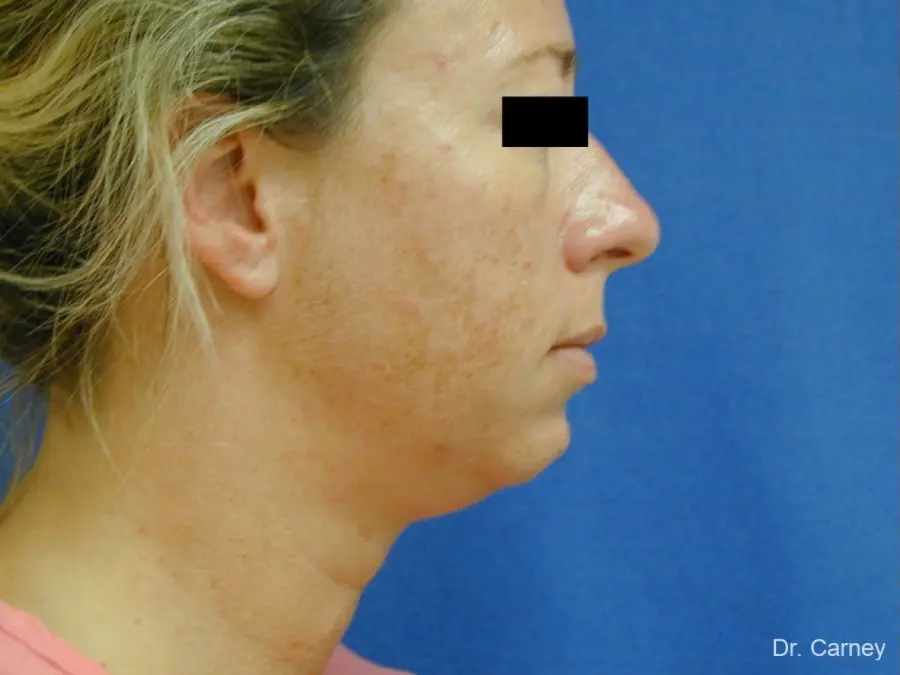 Neck Lift Real Patient Results by Dr. Martin Carney and Dr. Martin Carney III of The Carney Center in Virginia Beach and Newport News