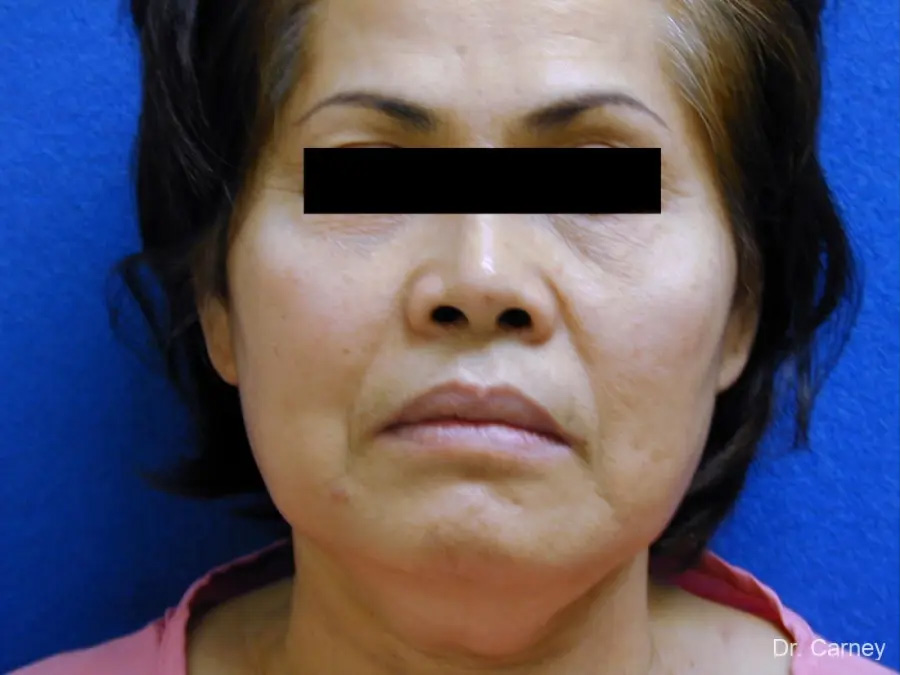 Neck Lift Real Patient Results by Dr. Martin Carney and Dr. Martin Carney III of The Carney Center in Virginia Beach and Newport News