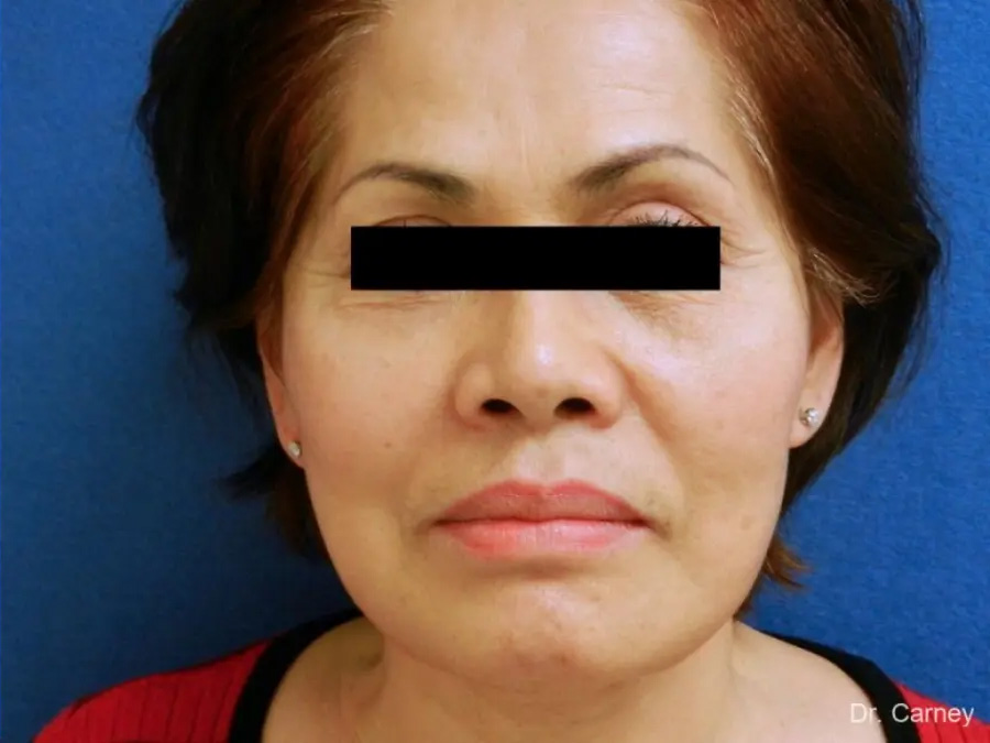 Neck Lift Real Patient Results by Dr. Martin Carney and Dr. Martin Carney III of The Carney Center in Virginia Beach and Newport News