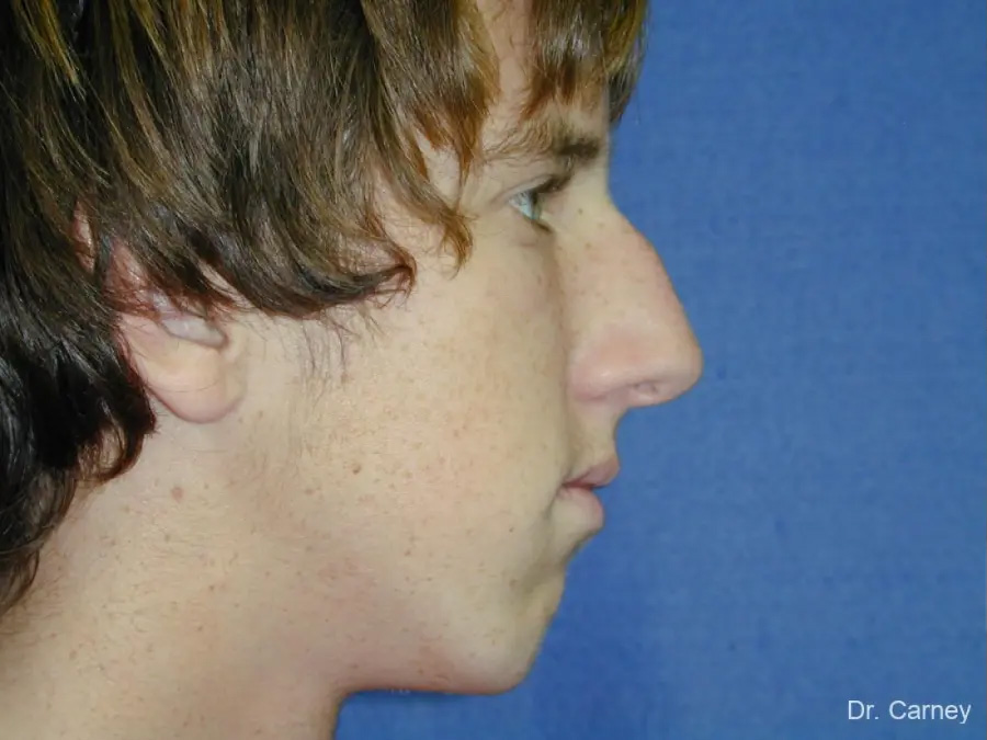 Rhinoplasty Real Patient Results by Dr. Martin Carney and Dr. Martin Carney III of The Carney Center in Virginia Beach and Newport News