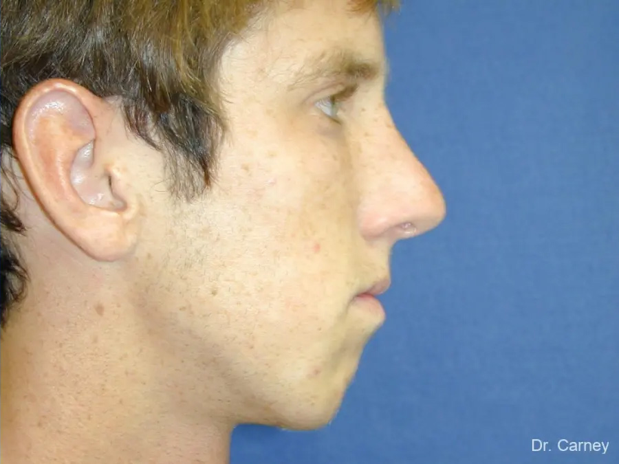 Rhinoplasty Real Patient Results by Dr. Martin Carney and Dr. Martin Carney III of The Carney Center in Virginia Beach and Newport News