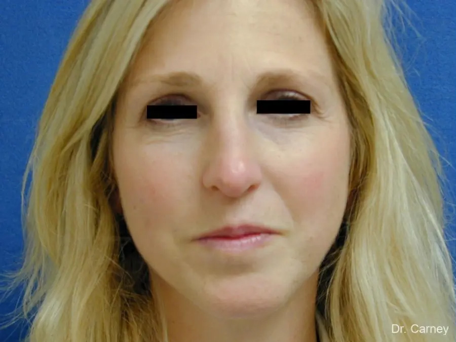 Rhinoplasty Real Patient Results by Dr. Martin Carney and Dr. Martin Carney III of The Carney Center in Virginia Beach and Newport News