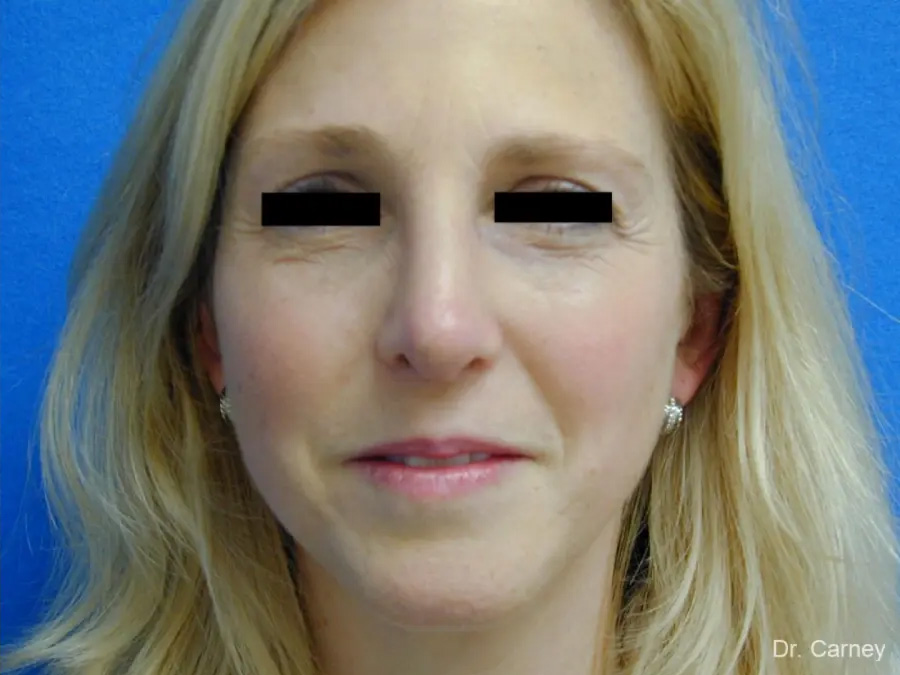 Rhinoplasty Real Patient Results by Dr. Martin Carney and Dr. Martin Carney III of The Carney Center in Virginia Beach and Newport News