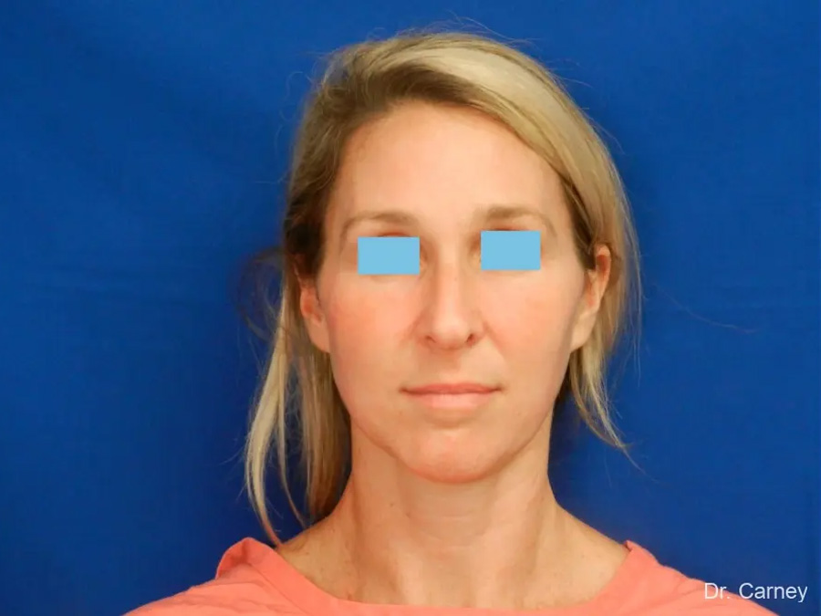 Rhinoplasty Real Patient Results by Dr. Martin Carney and Dr. Martin Carney III of The Carney Center in Virginia Beach and Newport News