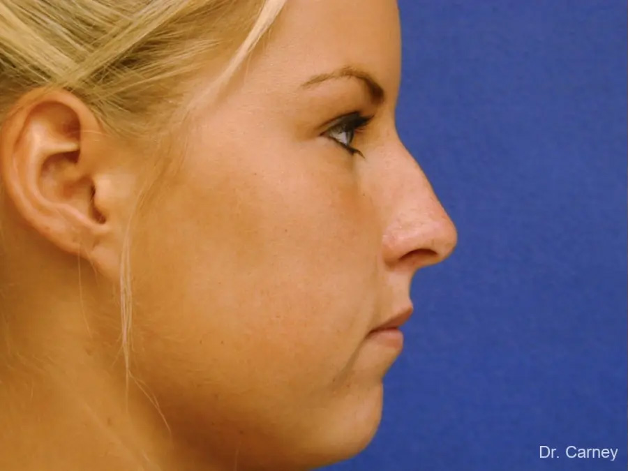 Rhinoplasty Real Patient Results by Dr. Martin Carney and Dr. Martin Carney III of The Carney Center in Virginia Beach and Newport News