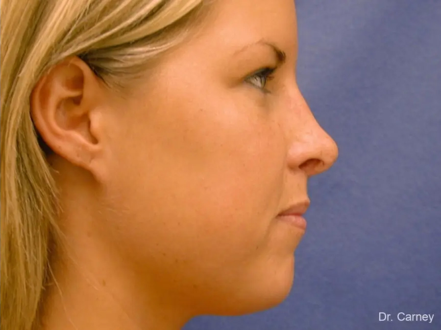 Rhinoplasty Real Patient Results by Dr. Martin Carney and Dr. Martin Carney III of The Carney Center in Virginia Beach and Newport News