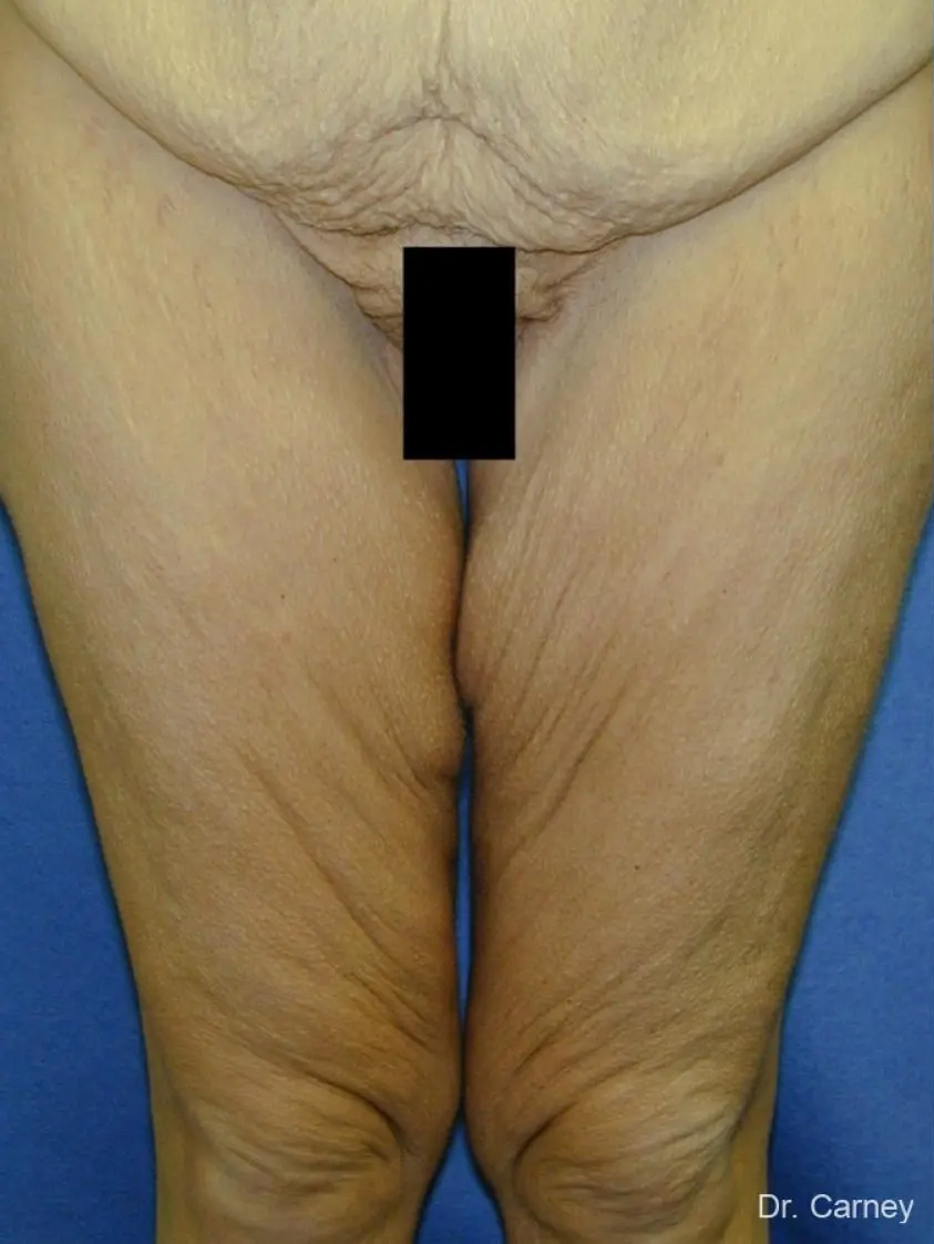 Thigh Lift Real Patient Results by Dr. Martin Carney and Dr. Martin Carney III of The Carney Center in Virginia Beach and Newport News