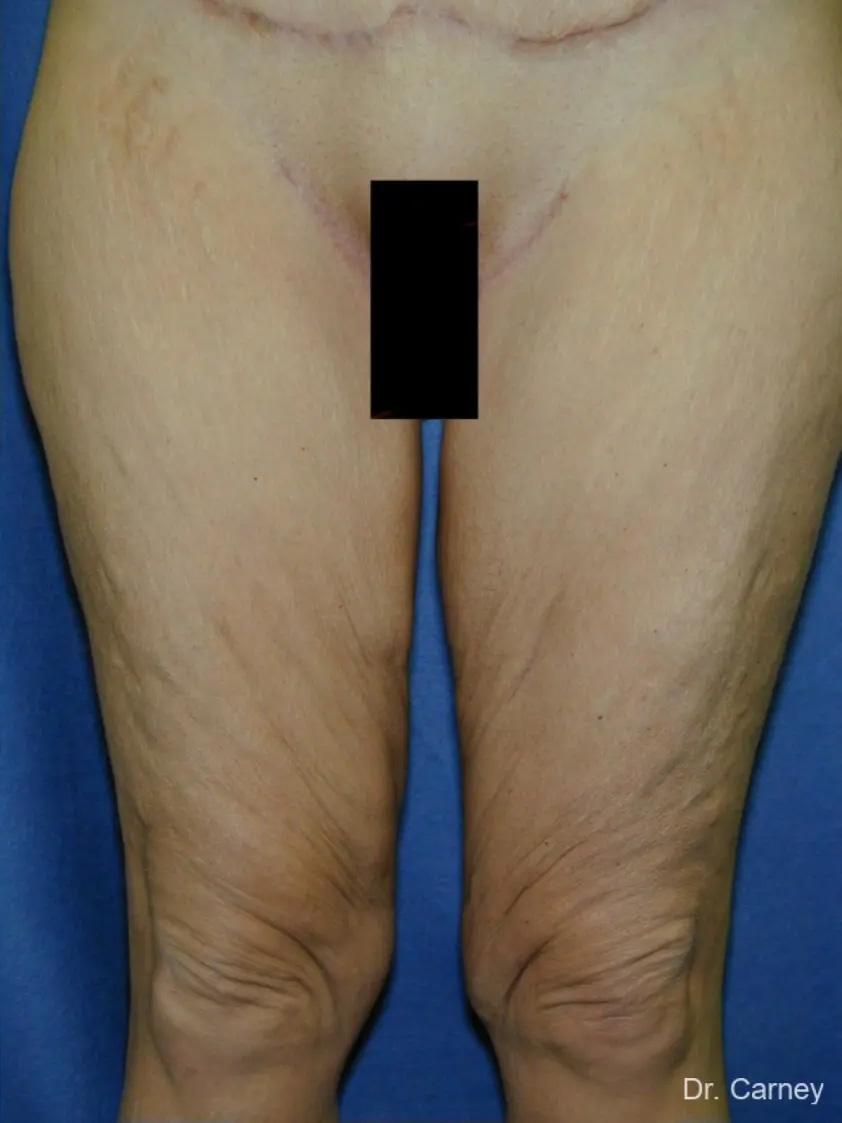 Thigh Lift Real Patient Results by Dr. Martin Carney and Dr. Martin Carney III of The Carney Center in Virginia Beach and Newport News