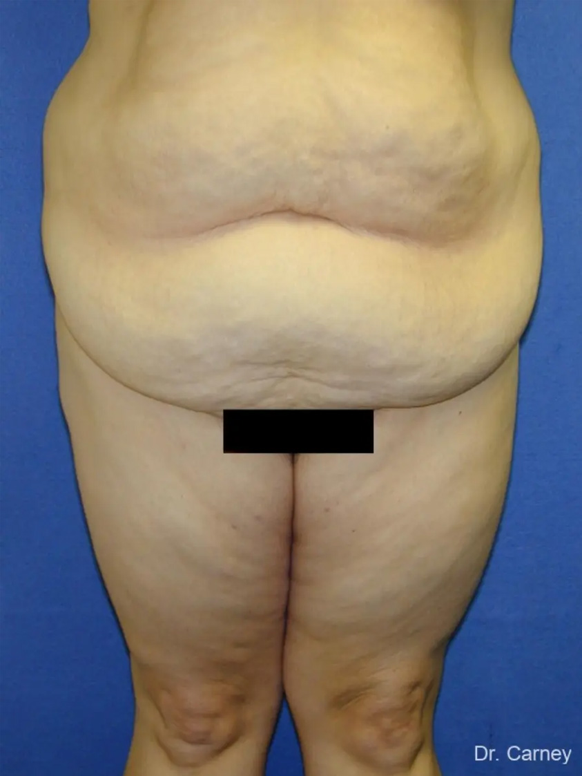 Thigh Lift Real Patient Results by Dr. Martin Carney and Dr. Martin Carney III of The Carney Center in Virginia Beach and Newport News