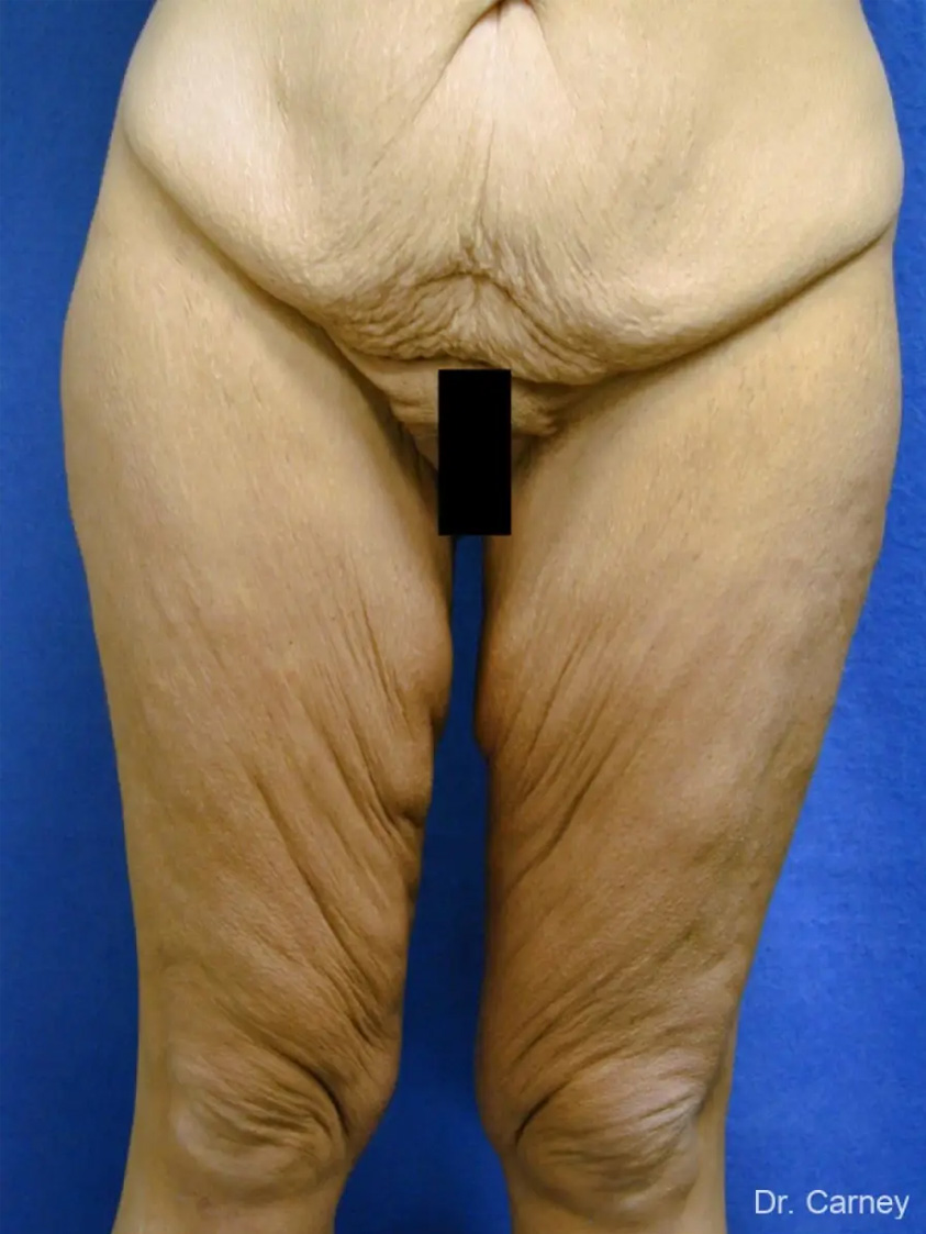 Thigh Lift Real Patient Results by Dr. Martin Carney and Dr. Martin Carney III of The Carney Center in Virginia Beach and Newport News
