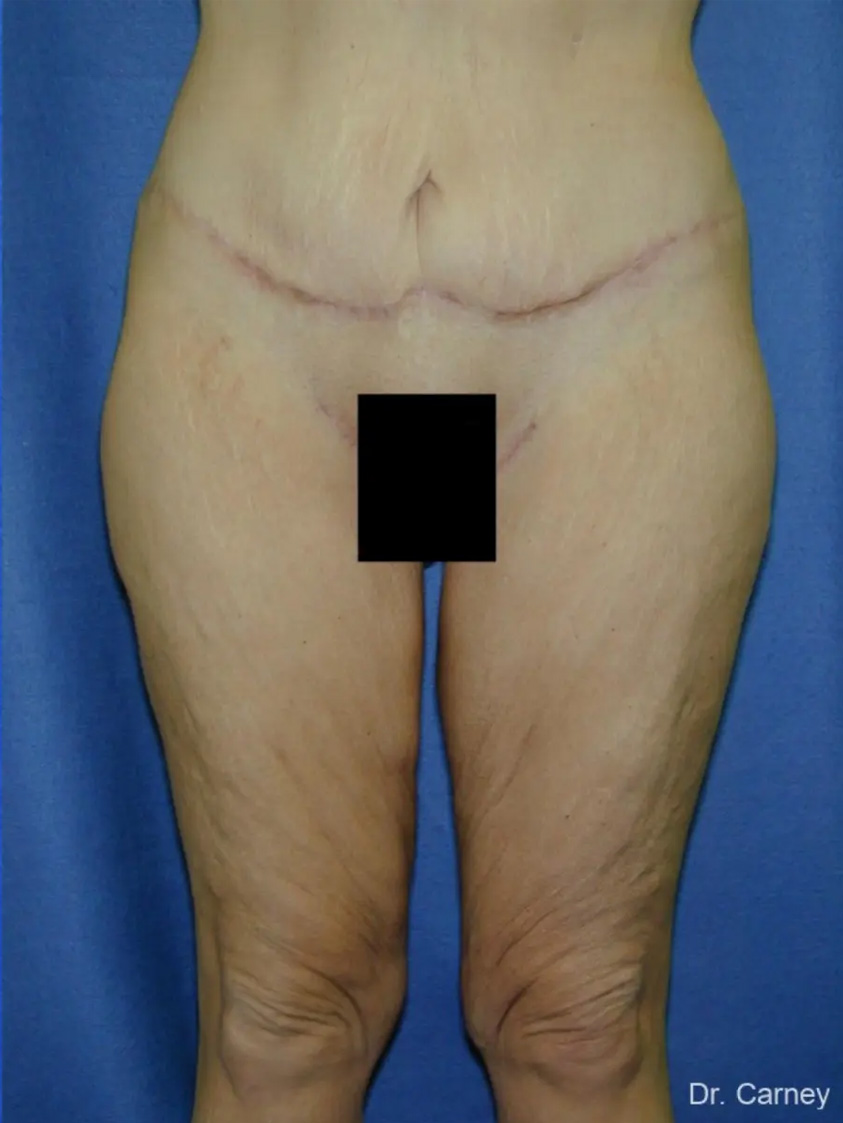 Thigh Lift Real Patient Results by Dr. Martin Carney and Dr. Martin Carney III of The Carney Center in Virginia Beach and Newport News