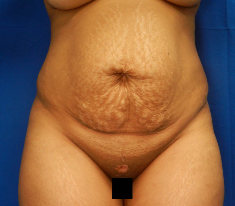 1_0010_Buttock-Aug-Before1.1.JPG