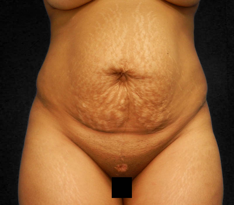 1_0010_Buttock-Aug-Before1.1.JPG.jpg