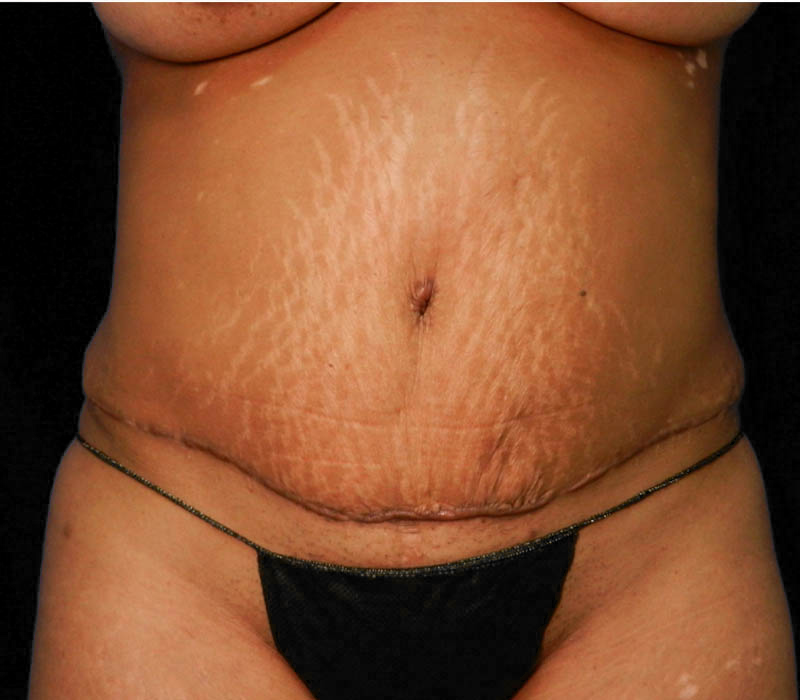 1_0011_Buttock-Aug-After1.1.JPG.jpg