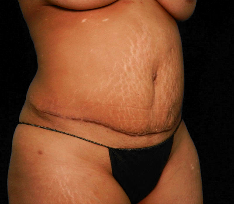 1_0013_Buttock-Aug-After1.2.JPG.jpg