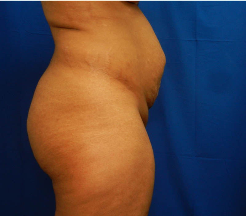 1_0014_Buttock-Aug-Before1.3.JPG