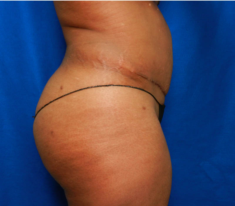 1_0015_Buttock-Aug-After1.3.JPG