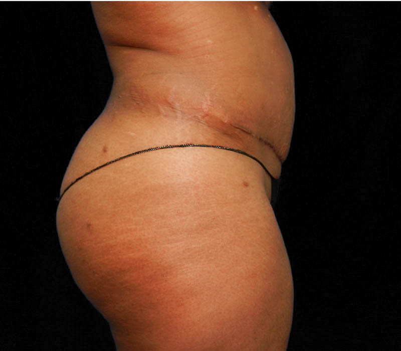 1_0015_Buttock-Aug-After1.3.JPG.jpg