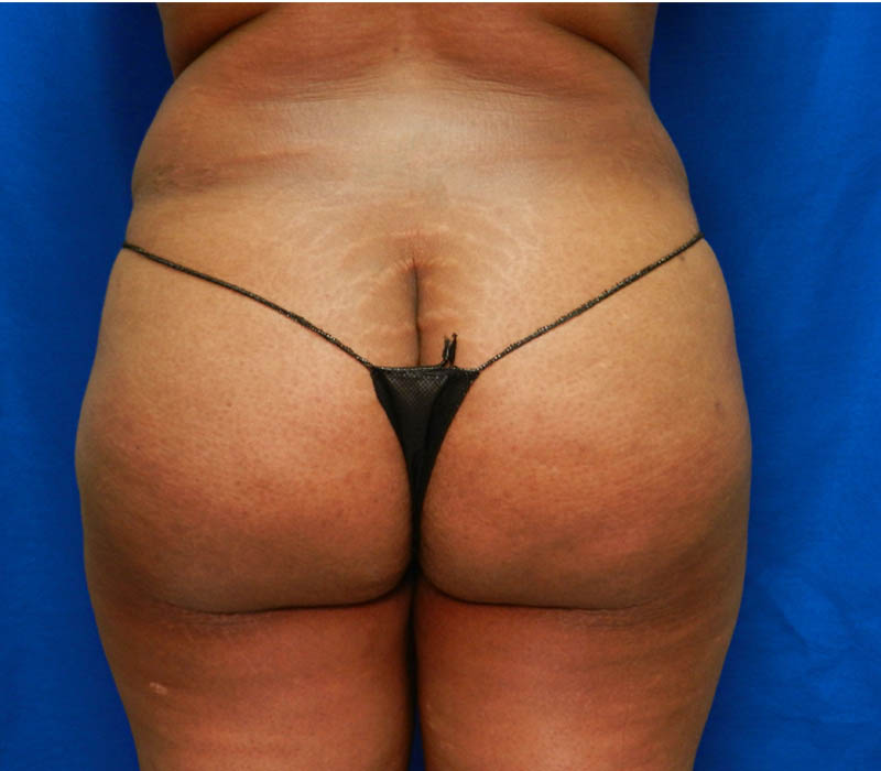 1_0016_Buttock-Aug-After1.4.JPG