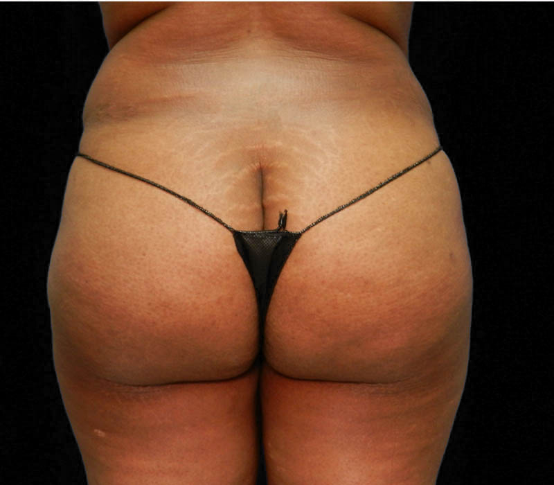 1_0016_Buttock-Aug-After1.4.JPG.jpg