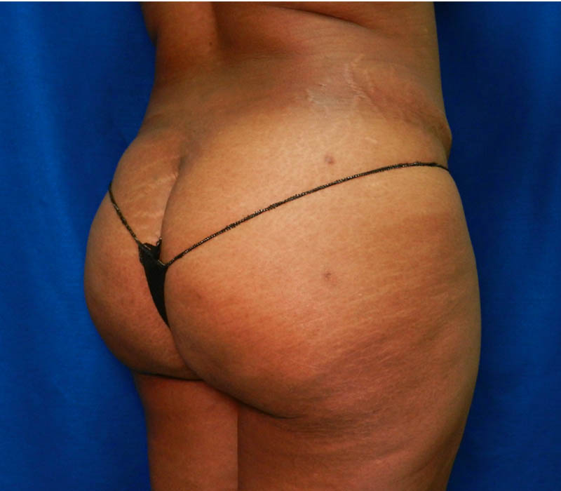1_0017_Buttock-Aug-After1.5.JPG