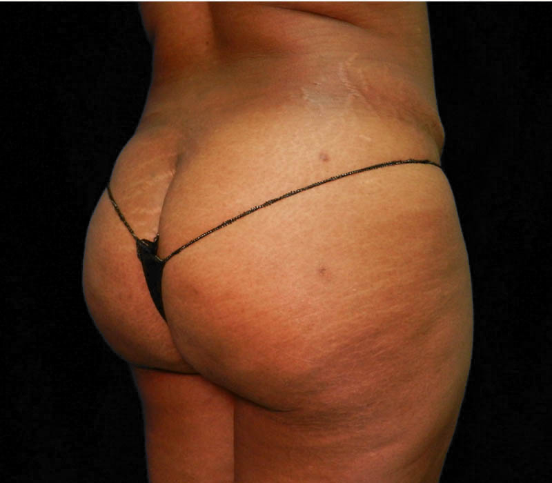 1_0017_Buttock-Aug-After1.5.JPG.jpg